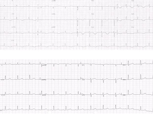 - Su Jin Jeong, et al. case of Sheehan s syndrome that presented with a pericardial effusion - Figure 1. Electrocardiogram showed a reduced QRS voltage ().