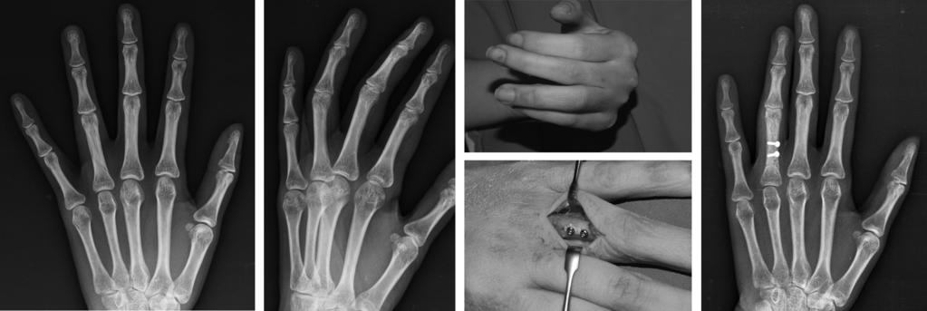 J Korean Soc Surg Hand Vol. 22, No. 3, September 2017 C A B D E Fig. 3. A 38-year-old woman was injured from traction injury resulting in minimally displaced spiral fracture on left 4th finger proximal phalanx.
