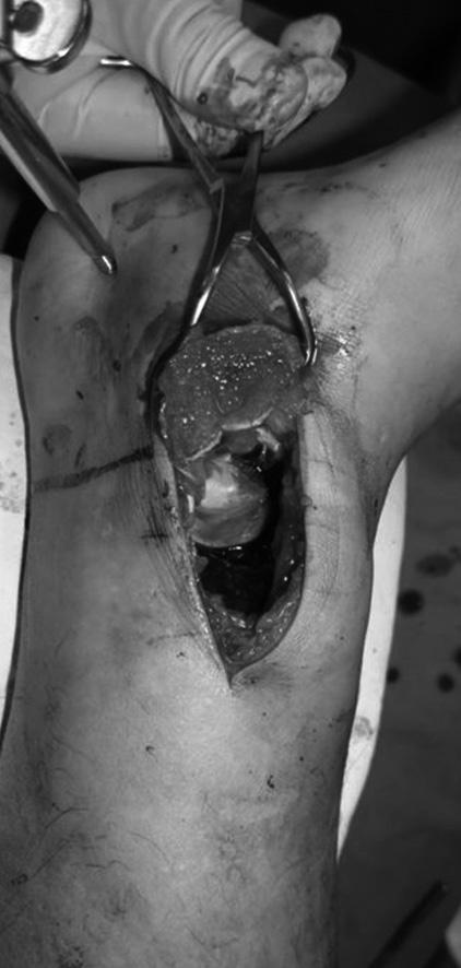 Intraoperative photograph shows a large distractor for ankle