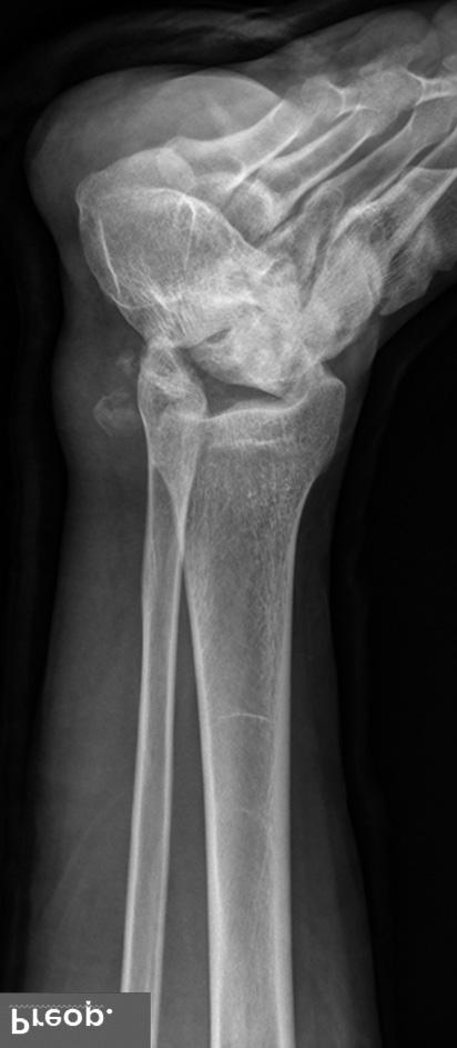 radiologic posttraumatic ankle arthritic change. Preop.