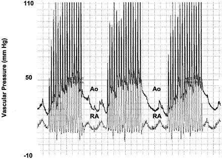 흉부압박이중단될경우 Coronary Perfusion Pressure = Aortic Pressure RA Pressure 심폐소생술중의관상동맥압 Berg RA, Sanders AB, Kern KB, et al.