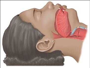 상기도폐쇄의흔한원인 혀 : 의식이저하된환자에서가장흔한원인 이물질흡인 후두연축 : 기도삽관