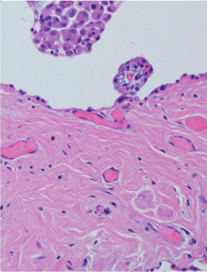 (B) High-magnification view showing hyalinized collagen deposition, hyperplastic smooth muscle bundles, and intra-alveolar macrophages
