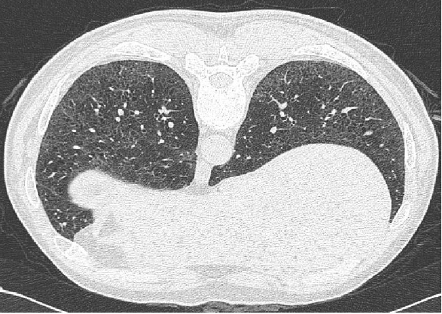 이 연구자는 흡 연 폐암 환자에서 얻어진 30개의 폐엽 중 4개에서 위와 같은 B 병변이 발견되지만, 비흡연자에서는 전혀 관찰되지 않는다 고 하였다.