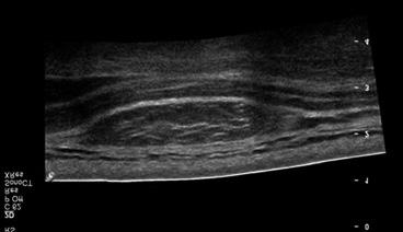295 Diagnostic Approach to a Soft Tissue Mass A B Figure 2. Ultrasonography findings of soft tissue masses. (A) These appearances are characteristic of lipoma.