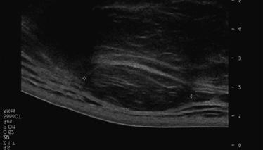 Ultrasound image shows an encapsulated subcutaneous mass isoechoic to the adjacent subcutaneous fat and fine internal echogenic striations parallel to the long axis of the