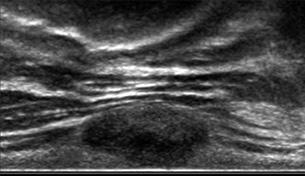 (A) Longitudinal forearm ultrasound shows a fusiform heterogeneous, hypoechoic mass in continuity with the ulnar nerve with posterior acoustic enhancement.