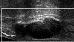 (B) Transverse color Doppler ultrasound of the same lesion shows a moderate degree of intralesional hypervascularity. Note the moderate posterior acoustic enhancement.