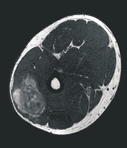 (B-b) Axial T2WI shows mixed signal intensity. (B-c) T1WI FS MRI shows heterogeneous enhancement. A malignant finding in MRI, pleomorphic liposarcoma in the pathology examination. 정이나고립성폐결절을감별할수있게되었다.