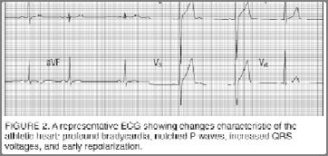 비정상적인 EKG의요점은상승된미주신경긴장, 감소된교감신경긴장그리고생리학적인비대에의해서이다. 운동선수의안정시 EKG에서주로보이는것은서맥. 때때로 1분에 25박이하로느리게뛰는경우도있다. AV block (1도, 2도, 3도등 ) 도발견된다.