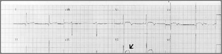 The Athlete s Electrocardiogram EKG of an individual with changes characteristic of the athletic heart 12-lead EKG : 심혈관계평가의중요한진단적도구 심박수, 리듬, 전도등이정상적인범위내에서변화가다양함 서맥 :