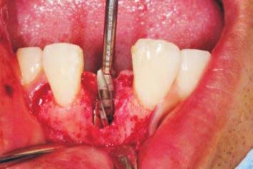 (A) After implant insertion in the correct position, autologous bone is placed into the