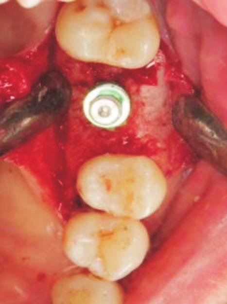 Case Report A B Fig. 11. Intraoral photographs of implant placement.