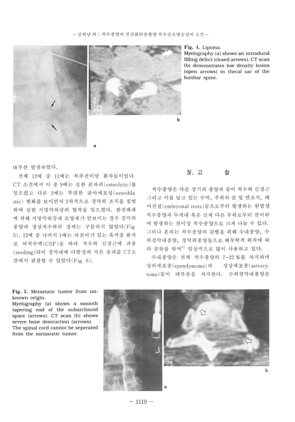 김학남외. 척수종양의전산화단층촬영척수강조영술상의소견 { Fig. 4. Lipoma Myelography (a) shows an intradural filling defect (closed arrows).
