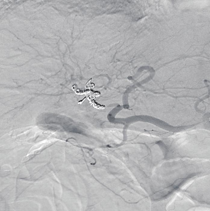 (B) After embolization, the arterogram shows coils obstructing right hepatic artery with complete