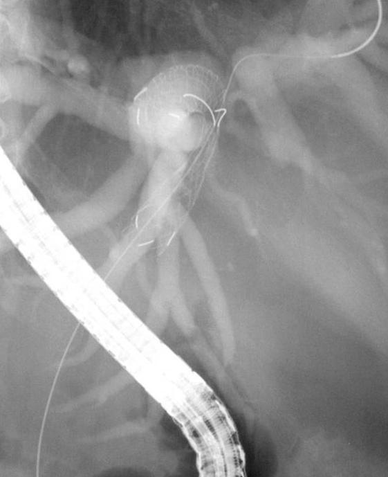 김표준 외 Figure 1. ERCP findings. How to use the Soehendra Stent Retriever: stent in stent methods.