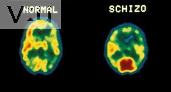 조현병원인 : 뇌의기능적이상 Functional MRI