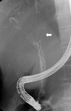 김선민외 7 인 52 A B C Fig. 1. (A) There is no radiocontrast passage to the left intrahepatic bile duct due to tumor regrowth on endoscopic retrograde cholangiopancreatography (arrow).