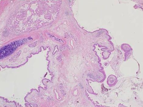(B) Histological finding of the congenital cystic adenomatoid malformation. A normal bronchus is seen at the left, and the lesions are on the right.