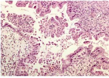298 안긍환 Fig. 17. Mucinous borderline tumor of endocervical-like(mullerian) type.