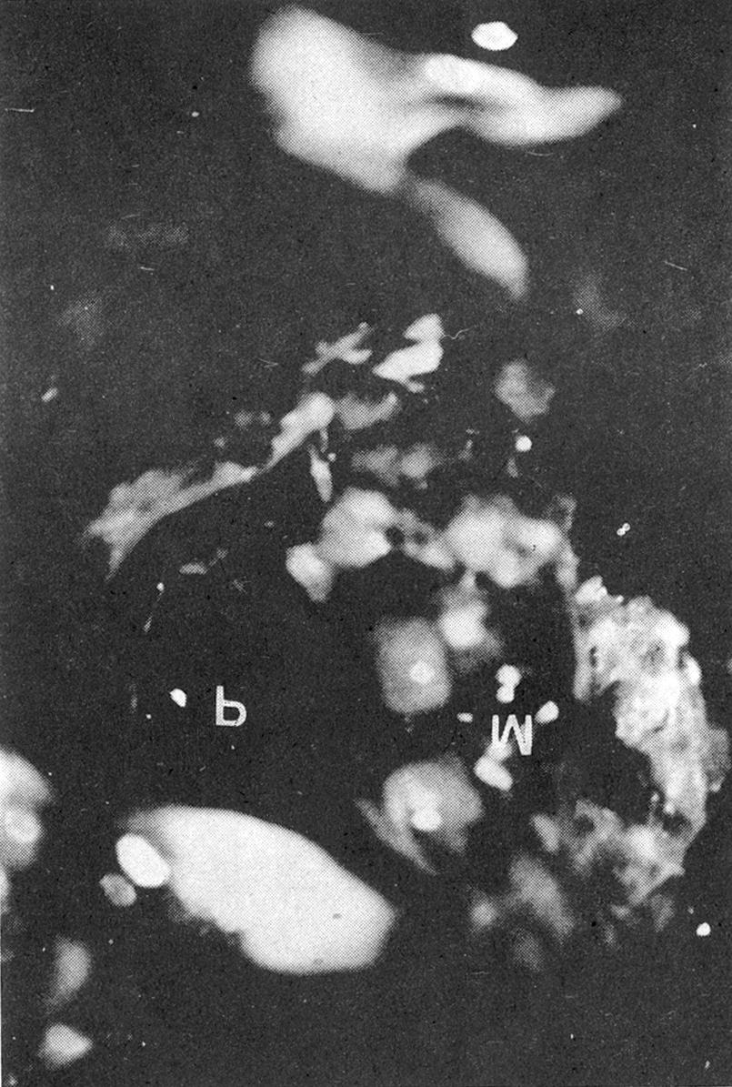 종물은 안면신경의 측두골외분지에서 기 원하여 경유돌공을 통하여 수평분절까지 침범한 소견을 보이고 있었다(Fig. 7). 종물제거후 안면신경은 3.5cm Fig. 1. Temporal CT, axial view(caseⅠ).