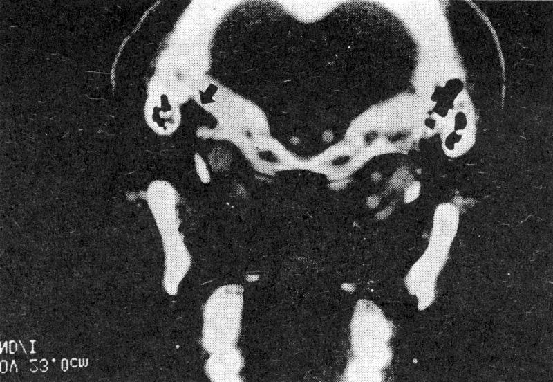증 례 3 42세 남자환자가 1996년 1월 29일 3년간 지속된 좌측 외이도 종물을 주소로 본원에 내원하였다. 이학적 Fig. 6.