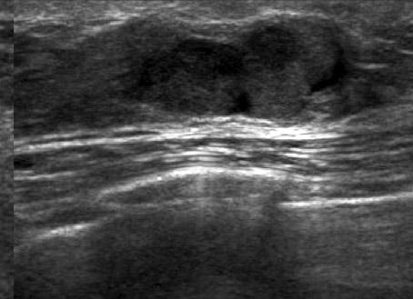 US of left outer subareolar region shows mild ductectasia with an isoechoic intraductal lesion