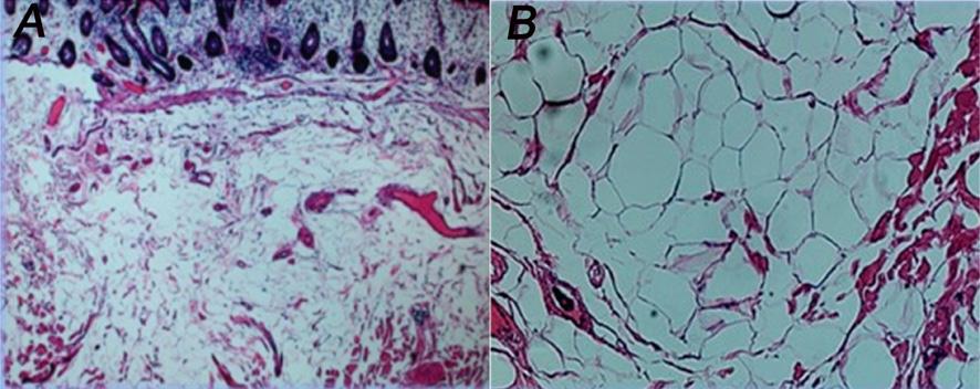 Figure 4. Microscopic examination of the submucosal colonic tumor confirmed its lipomatous nature and the submucosal position of the polyps (left: H&E stain, 100, right: H&E stain, 400).