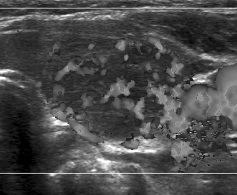 Graves' Disease Following Subacute Thyroiditis (Fig. 4). 내원 4개월째 다시 시행한 갑상선스캔은 이전 도플러 검사에서 갑상선 실질에 혈류 분포는 증가되어 결과와 비교하여 볼 때 갑상선이 전반적으로 커져 있 있었다.