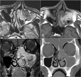 The massfilling the right nasal vestibule shows focal hyperintensity on T1-weighted image (A), hypointensity on T2-weighted image (B) and strong