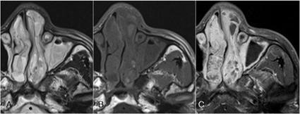 부비동염의단순촬영에서의정확성은상악동에서가장높으나 63-82% 에그쳐 5 이때문에부비동염의진단수단으로단순촬영보다는 CT 를선호하게된다. 급성부비동염에서는 air-fluid level 이나타난다(Fig. 6). Fig. 6. 28-year-old male. Acute maxillary sinusitis.