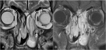 Poorly differentiated carcinomaarising from the right sphenoid sinus shows contrast enhancement.