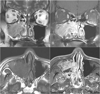 12 수술시발원지를완전히제거해야재발하지않는데,CT에서는발원지 13 가 sclerotic하여구분이잘되지만 MR영상에서는잘보이지않을수도있다 (Fig. 14). 강영상에서종양의부위를가름한다 (Fig. 13). Fig. 13. 15-year-old male. Juvenile angiofibroma in the right nasal cavity.