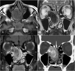 The lesion shows low signal intensity on T1- (A) and T2-weightedimages and inhomogenous contrast enhancement on Gd-T1-weighted image (C) and postcontrast CT image (D). 4.