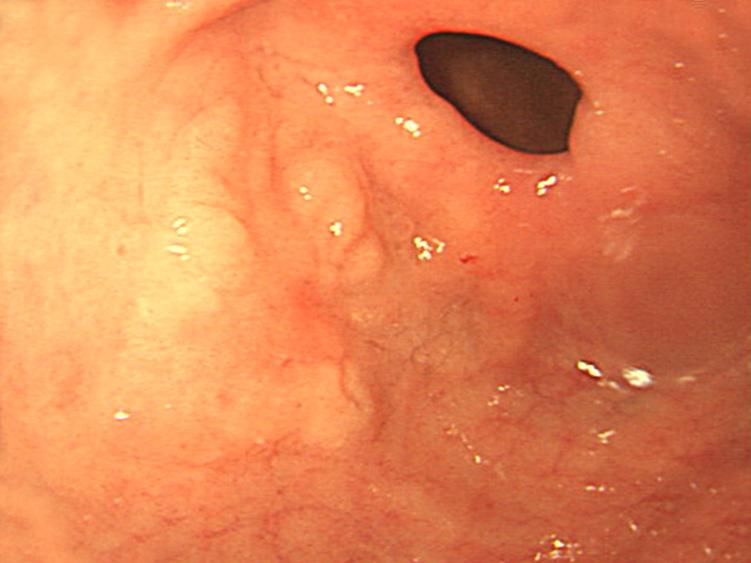40) of the resected specimen (epithelial dysplasia, low grade). (C) Endoscopic finding.
