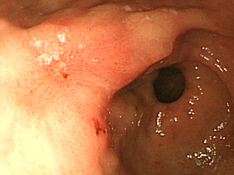 130 The Korean Journal of Gastroenterology: Vol. 51, No. 2, 2008 Fig. 3. Endoscopic findings.