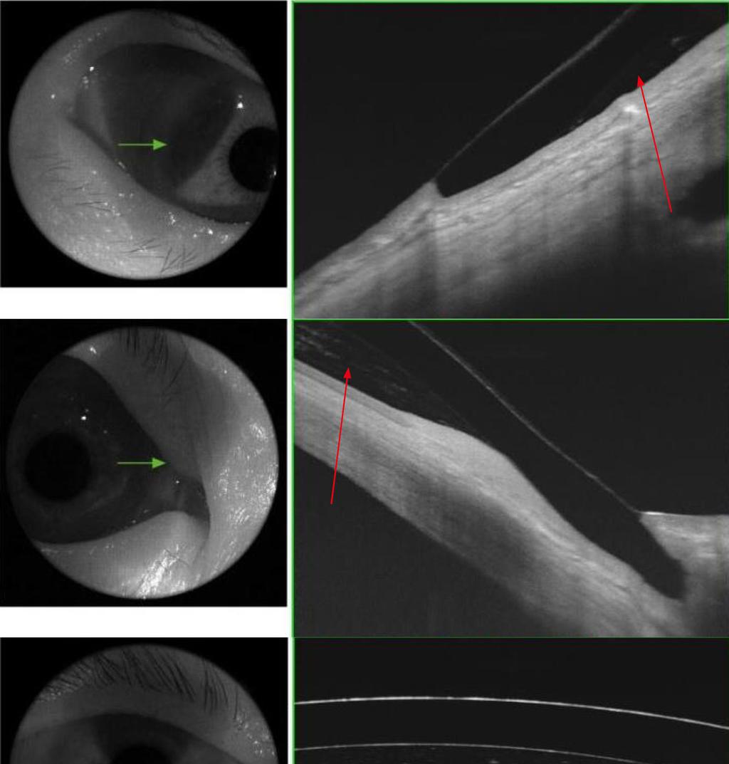 - 백진욱외 : 스티븐스존슨증후군과각막확장증 - A B C Figure 4. Tear film (arrows) between the cornea and the miniscleral lens is well positioned along the cornea with clear apical corneal clearance.