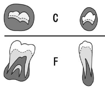 대한소아치과학회지 35(2) 2008 Fig. 1. The stages of tooth calcification (From Dermijian, 1978 33) ). C stage : Enamel formation is complete at the occlusal surface. Dentinal deposition has commenced.