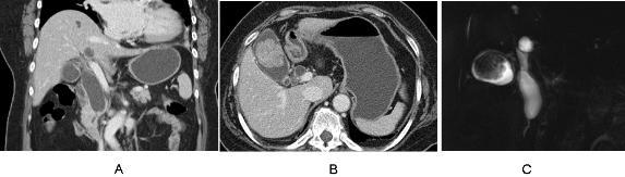 Fig. 3. A 64-year-old female with a type IC choledochal cyst and an AUPBD combined with GB cancer.