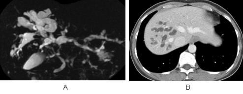 Fig. 5. A 33-year-old female with a type IIA choledochal cyst and a type Ib AUPBD combined with GB cancer.