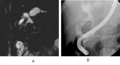 Fig. 7. A 62-year-old female with a type IVA choledochal cyst and a type IIb AUPBD, combined with cancer in the GB and the choledochal cyst. A. ERCP image shows irregularly dilated common bile duct, common hepatic duct and intrahepatic bile ducts.