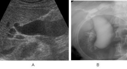 14 Combined stone * IVA IIIc3 Fig.1. A 43-year-old female with a type IVA choledochal cyst and a type Ia AUPBD. A. Ultrasound image shows segmental dilatation of intrahepatic bile ducts and cystic dilatation of the cmon bile duct.