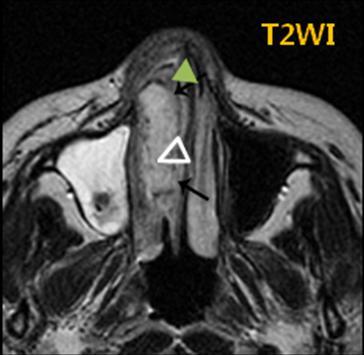 The mass is intermediate signal intensity (b) Axial T2-weighted image demonstrates right nasal mass has a heterogeneous high signal intensity.