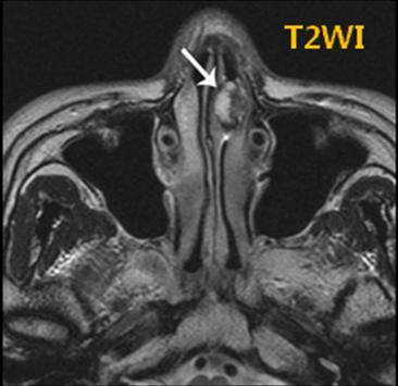 intermediate signal intensity with heterogeneous focal high signal intensity (white arrow) in the left anterior nasal cavity.