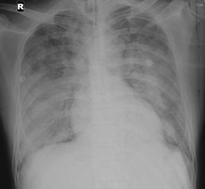 Eight days later, chest X-ray shows nearly normalized findings. (C) Table 1. Changes of arterial blood gas analysis findings.