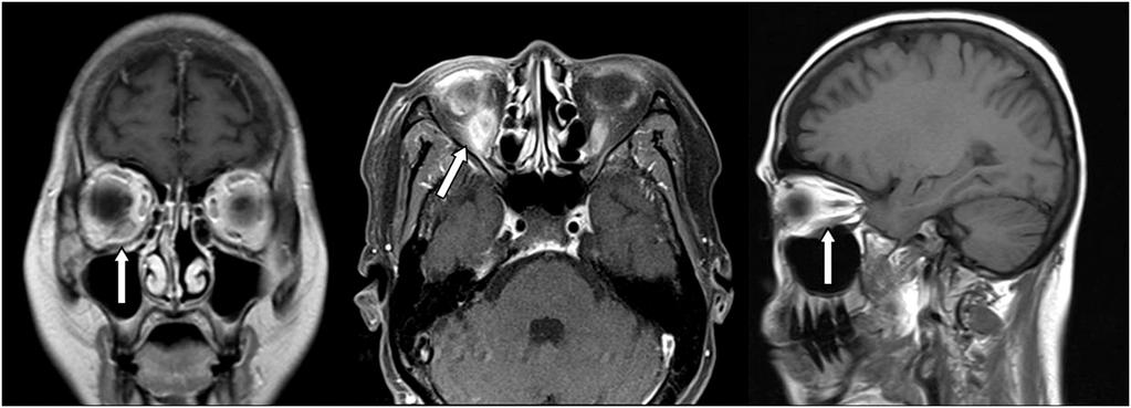 (B) Brain M RI scans showed a remnant cystic lesion (white arrow) with residual inflammation confirming the removal of a large abscess pocket. 좌안에 비해 2 mm의 안구돌출이 있었고, 제일안위 원거리 좌안 1.