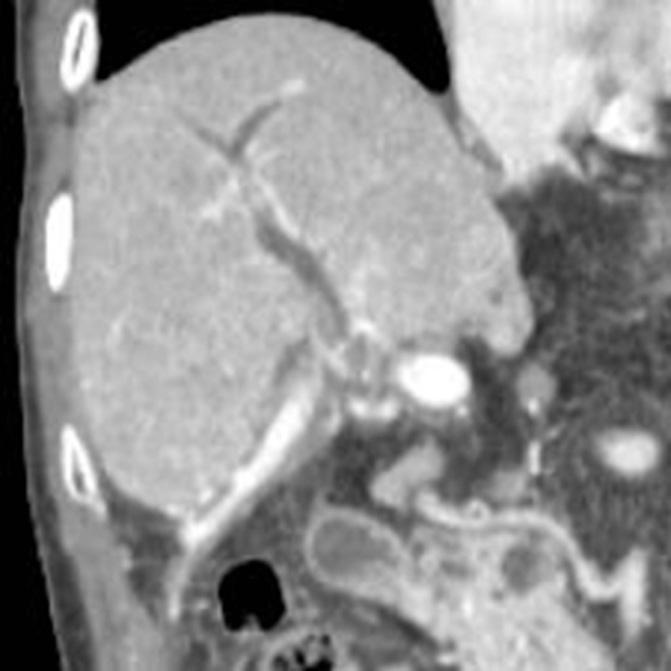 (A) Abdominal computed tomography scan shows soft tissue density at hepatic hilum with mild dilatation of the intrahepatic bile duct at the time of