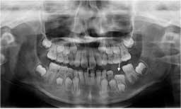대한소아치과학회지 36(3) 2009 Fig. 5. Panoramic view before extraction of intraoccluded left 2 nd primary molar.