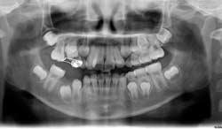 Initial panoramic view showing the infraocclusion of mandibular right 2 nd primary primary molar and mesial tilting
