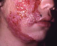 (A) Extensive weeping edematous swollen patches showing marginal induration and crust formation on the right side of the face,
